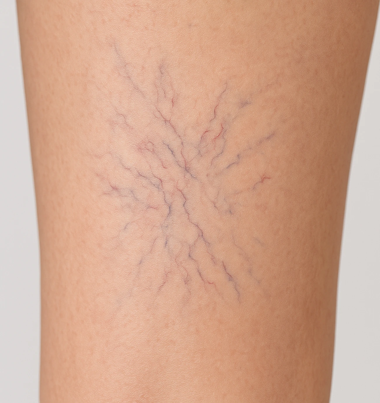 Spider Veins